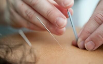 What is acupuncture?