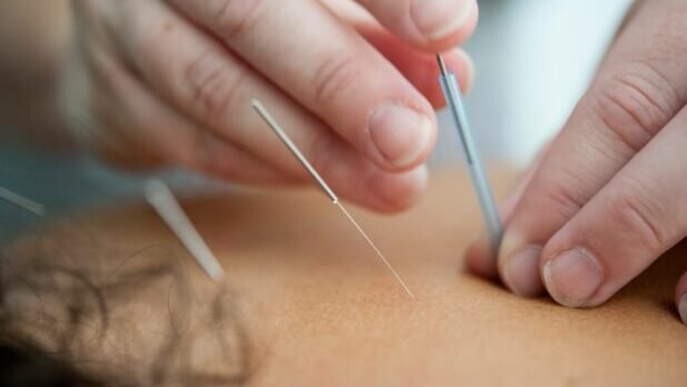 Acupuncture needling with a guide tube