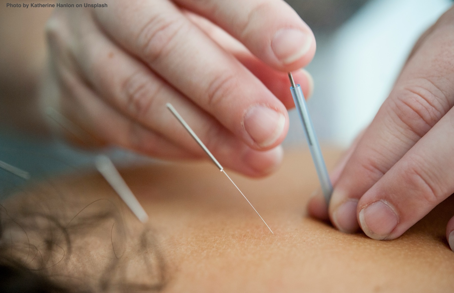 Acupuncture needling with a guide tube